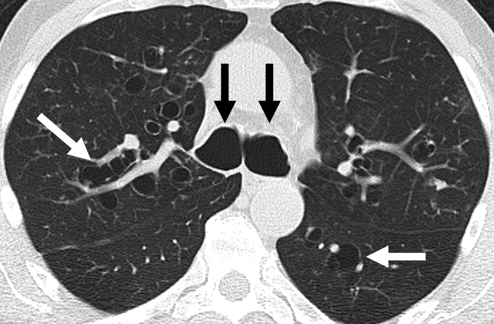 HRCT showing bronchiectasis with signet ring sign and dilated airways